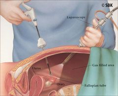 Illustration of laparoscopic infertility surgery 