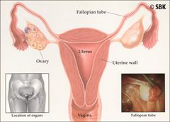 Illustration of tubal reversal