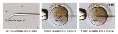 Photos of steps involved in sperm assisted hatching