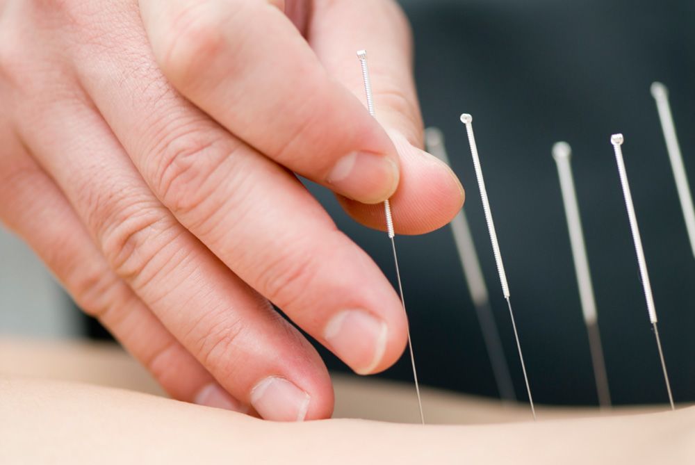 Acupuncture treatment